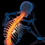 svc-spinal-arthritis-150x150